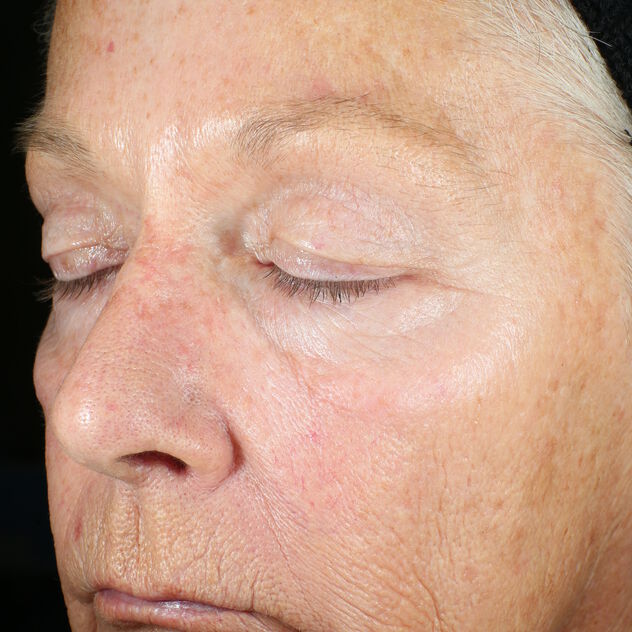 Wrinkle + Texture Repair before-after-1